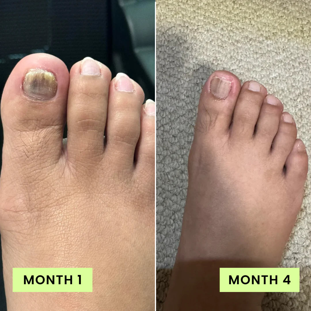 Lunavia™ Toenail Fungus Pen – Official & Original Nail Care - Review