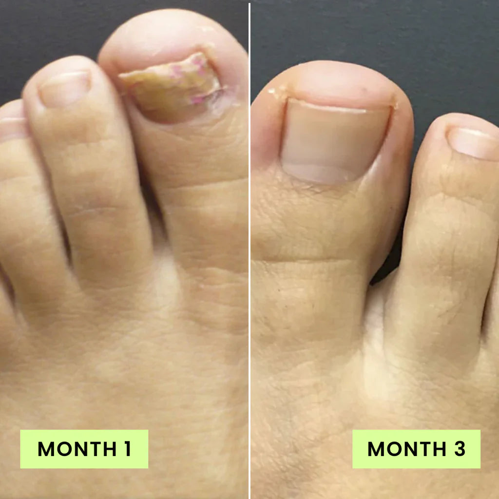 Lunavia™ Toenail Fungus Pen – Official & Original Nail Care - Review