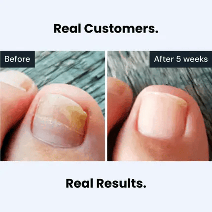 Lunavia™ Toenail Fungus Pen – Official & Original Nail Care - Results