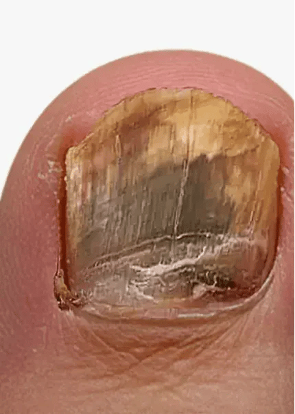 Lunavia™ Toenail Fungus Pen – Official & Original Nail Care - Showcase